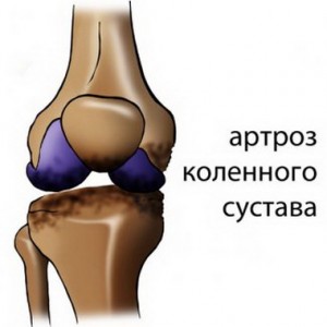Артроз коленного сустава.